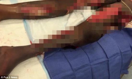 Dakarai Moore Jr was playing sport last Thursday when he felt a swelling behind his knee. Within days, he was hospitalized with blistering sores over his leg (pictured in hospital)